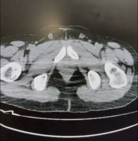 Midelerinde uyuşturucu sevkiyatı yapan 2 torbacı tutuklandı