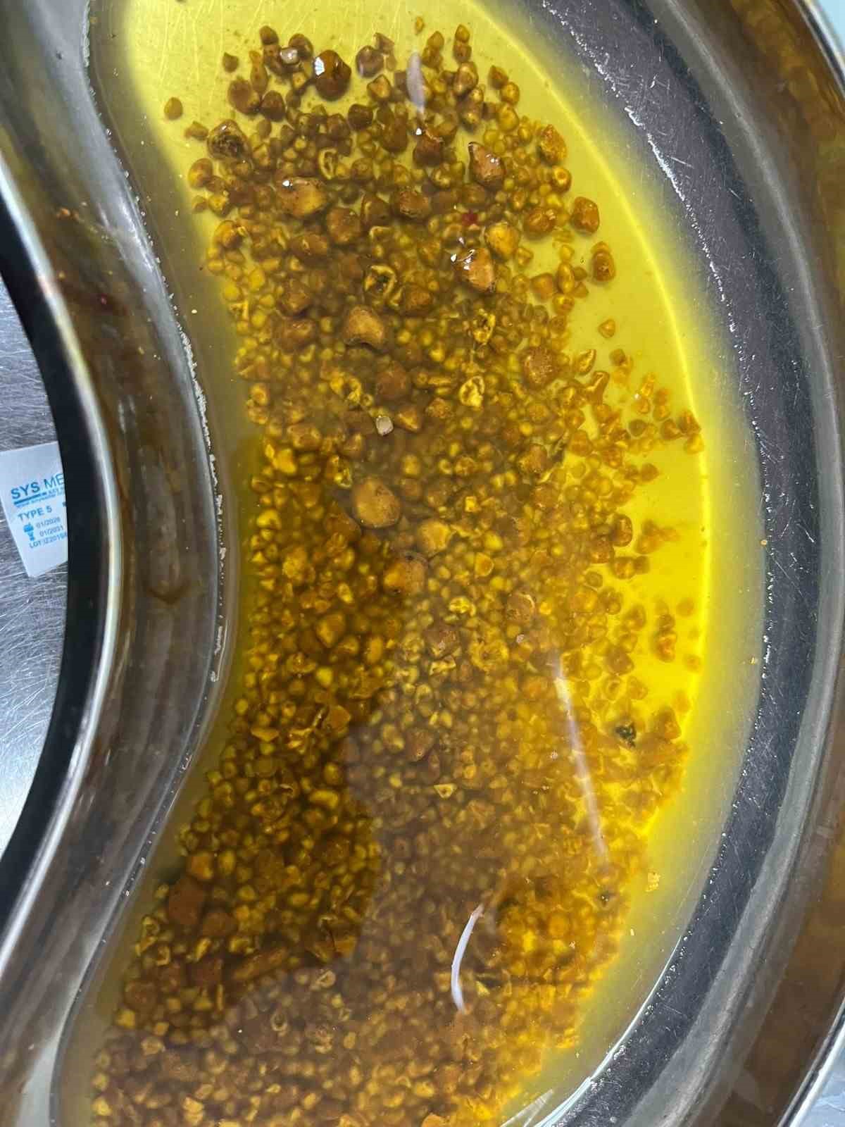 Bing&ouml;l&rsquo;de nadir vaka: Safra kesesinden 2 bin 67 taş &ccedil;ıkarıldı
