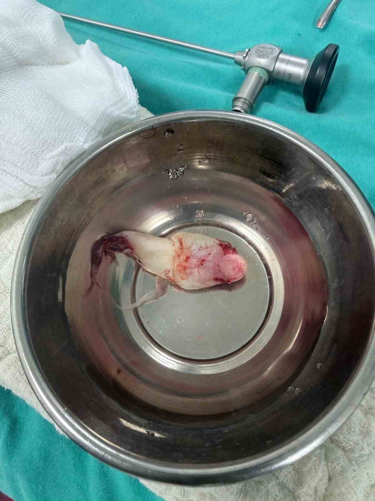 Burun tıkanıklığı ve işitme kaybı şikayetiyle gitti, ameliyatta dev bir polip çıkartıldı
