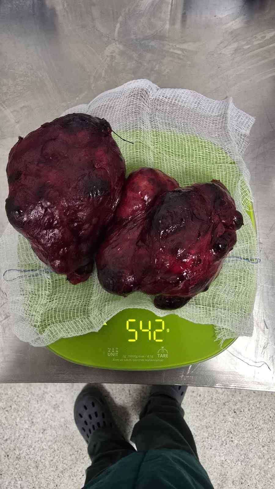 Boynundaki 542 gramlık kitle başarıyla &ccedil;ıkarıldı
