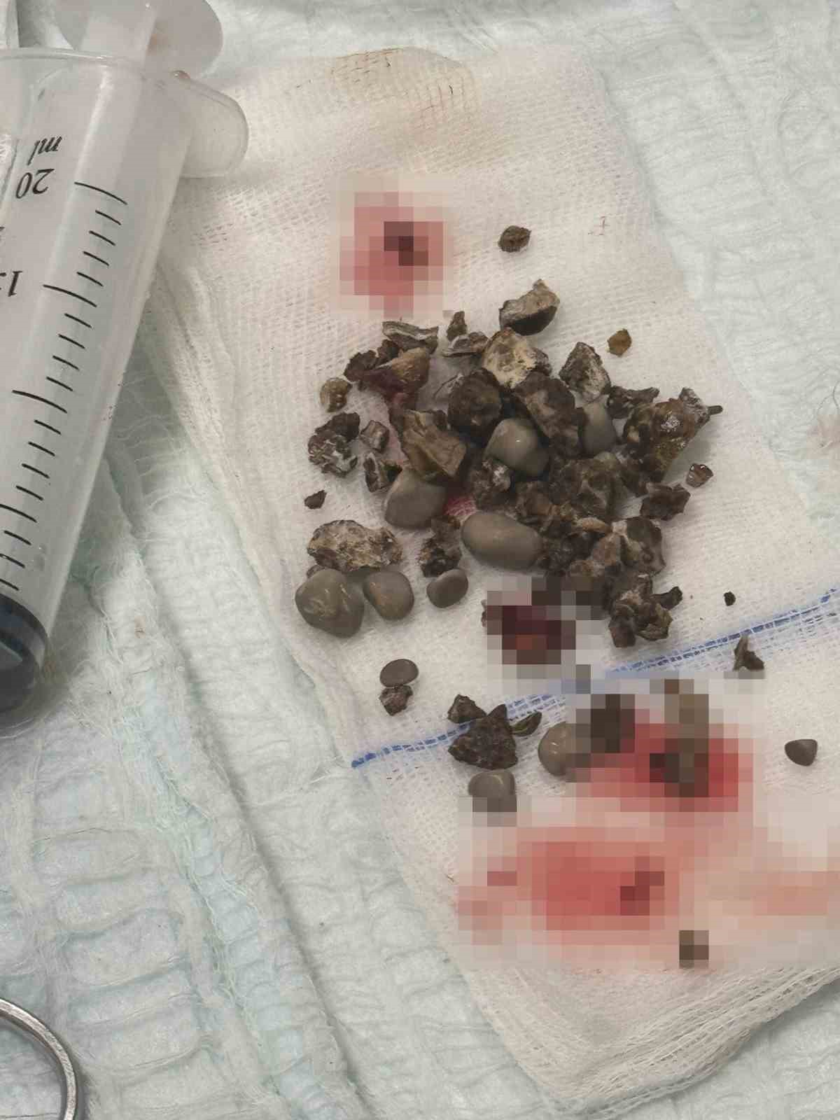 Siirt’te böbrek taşı hastasına ’nokta atışı’ müdahale