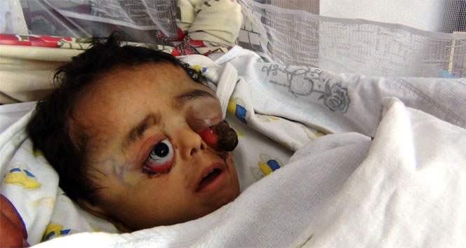 Tümör nedeniyle gözü dışarı fırladı