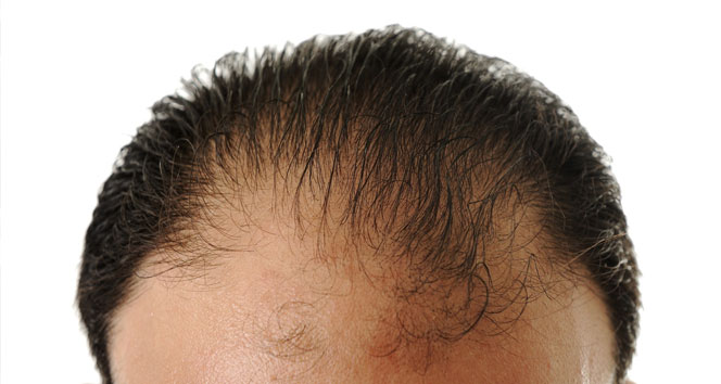 Saç dökülmesi hastalık işareti olabilir