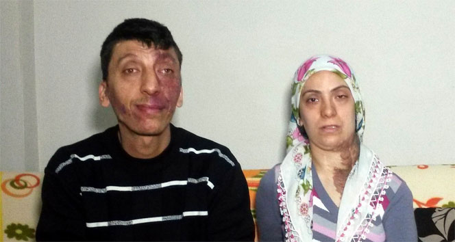 Yüzlerinde doğuştan yara olan kardeşlerin dramı