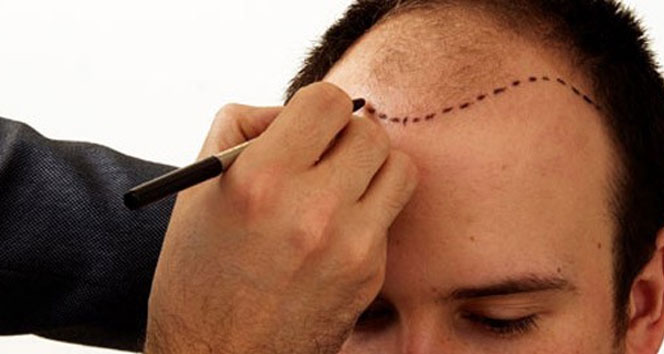 Kellik özgüven eksikliğine yol açıyor