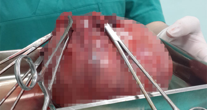 Rahminden dört kiloya yakın cisim çıkarıldı