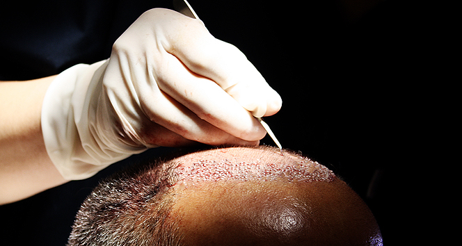 Organik saç ekimi saç sorunlarına kalıcı çözüm getiriyor