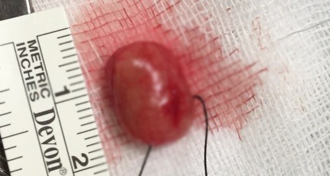 ‘Bel fıtığıyım’ dedi, omurilik tümörü çıktı